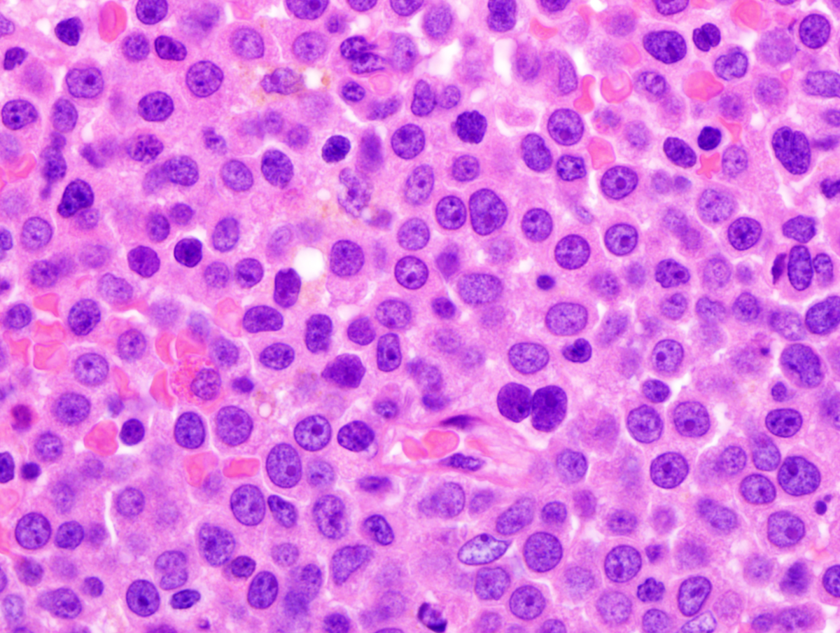 Image 3. Clot section demonstrates 100% cellularity with predominantly immature myeloid precursors. The maturing granulocytes exhibit prominent nuclear hypolobulation. Erythroid and megakaryocytes are markedly reduced.